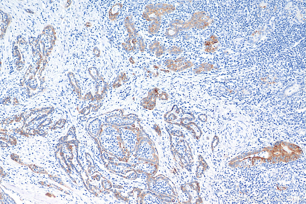 Immunohistochemistry (IHC) staining of human thyroid cancer tissue using Cytokeratin 19 Monoclonal antibody (60187-1-Ig)