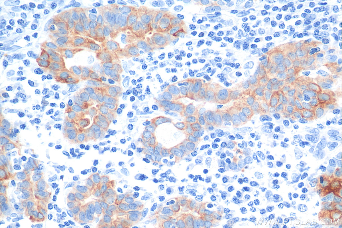 Immunohistochemistry (IHC) staining of human thyroid cancer tissue using Cytokeratin 19 Monoclonal antibody (60187-1-Ig)