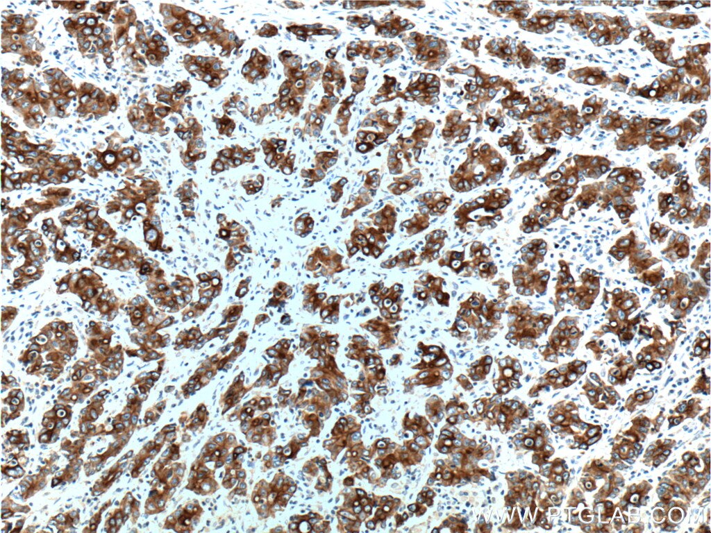 IHC staining of human stomach cancer using 60187-1-Ig