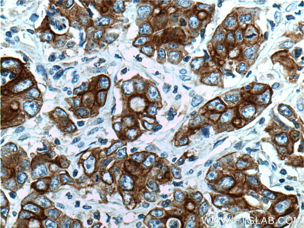 Immunohistochemistry (IHC) staining of human stomach cancer tissue using Cytokeratin 19 Monoclonal antibody (60187-1-Ig)