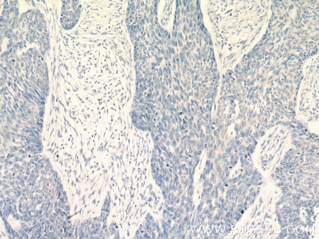 IHC staining of human skin cancer using 21725-1-AP