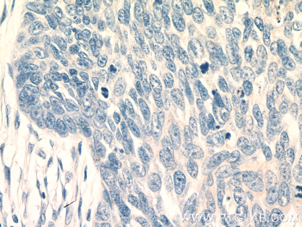 IHC staining of human skin cancer using 21725-1-AP
