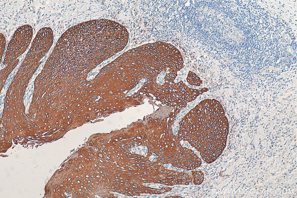 Immunohistochemistry (IHC) staining of human oesophagus cancer tissue using Cytokeratin 2e Polyclonal antibody (21725-1-AP)