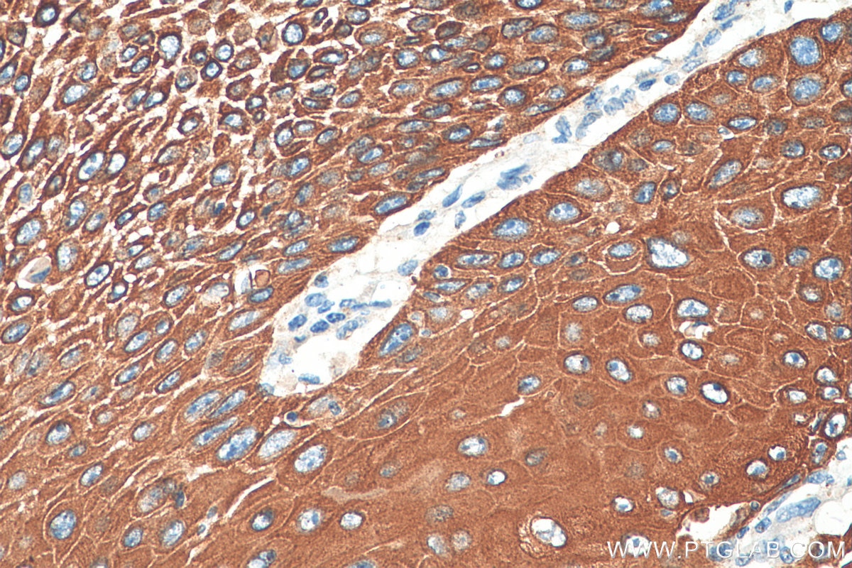 Immunohistochemistry (IHC) staining of human oesophagus cancer tissue using Cytokeratin 2e Polyclonal antibody (21725-1-AP)