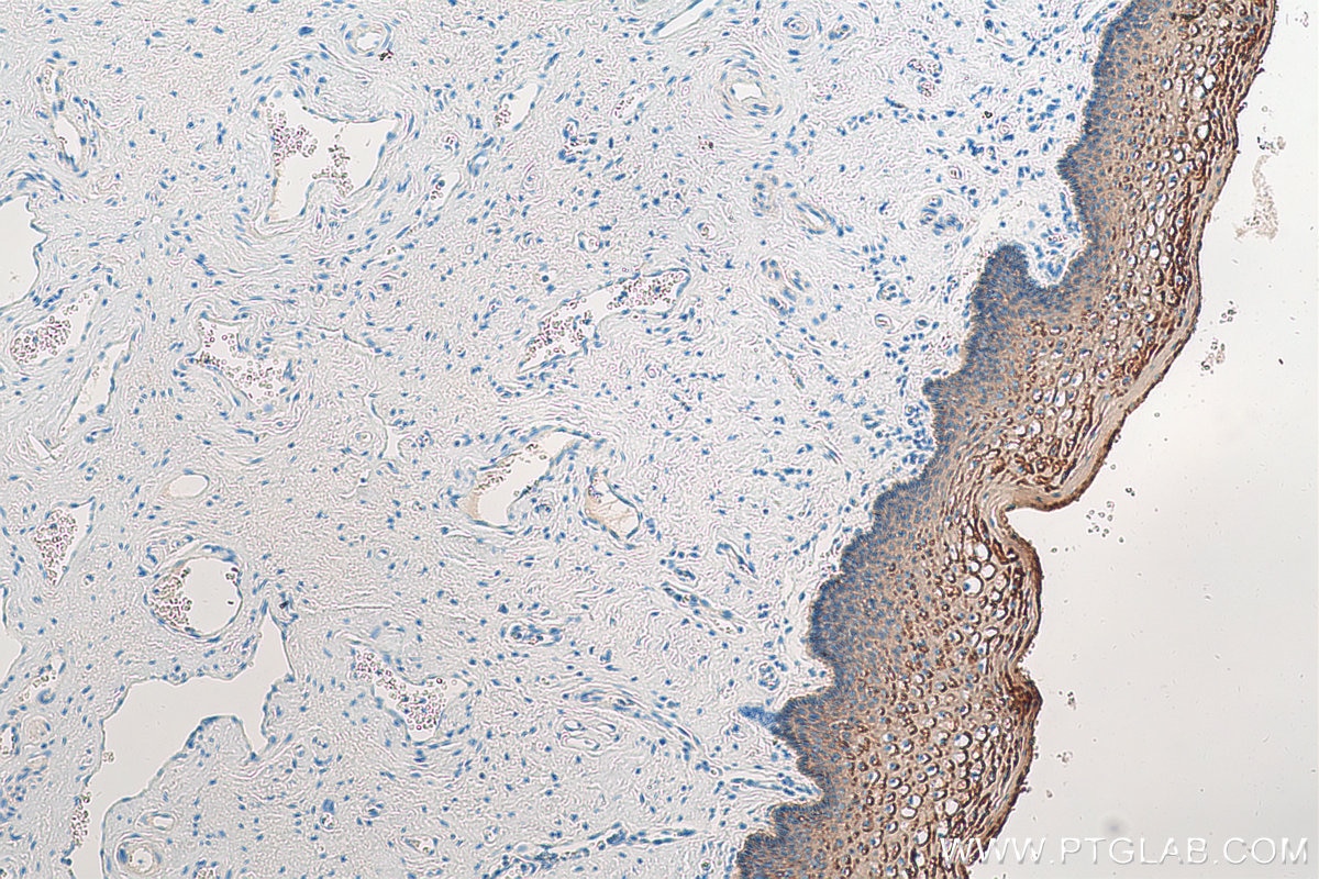 Immunohistochemistry (IHC) staining of human cervical cancer tissue using Cytokeratin 2e Polyclonal antibody (21725-1-AP)
