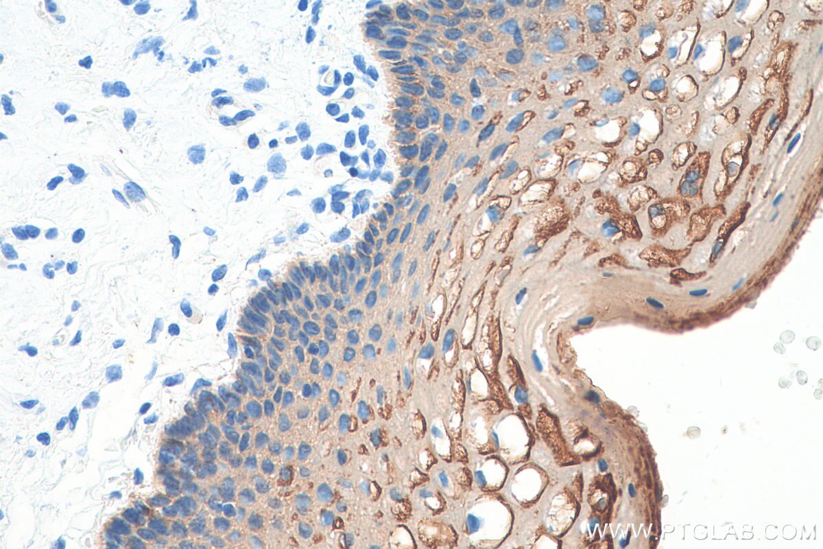 Immunohistochemistry (IHC) staining of human cervical cancer tissue using Cytokeratin 2e Polyclonal antibody (21725-1-AP)