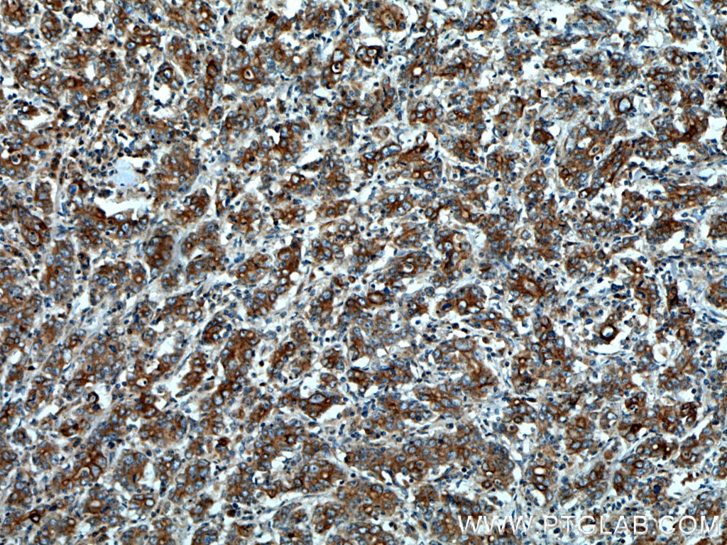 IHC staining of human stomach cancer using 17329-1-AP