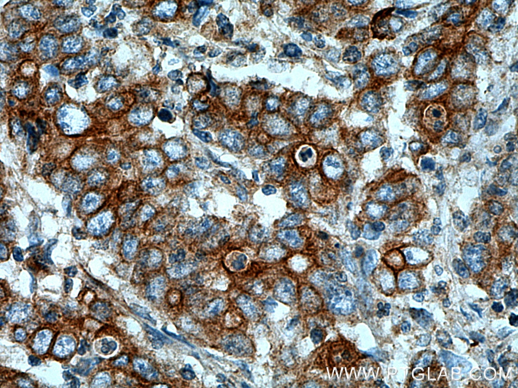Immunohistochemistry (IHC) staining of human stomach cancer tissue using Cytokeratin 20 Polyclonal antibody (17329-1-AP)