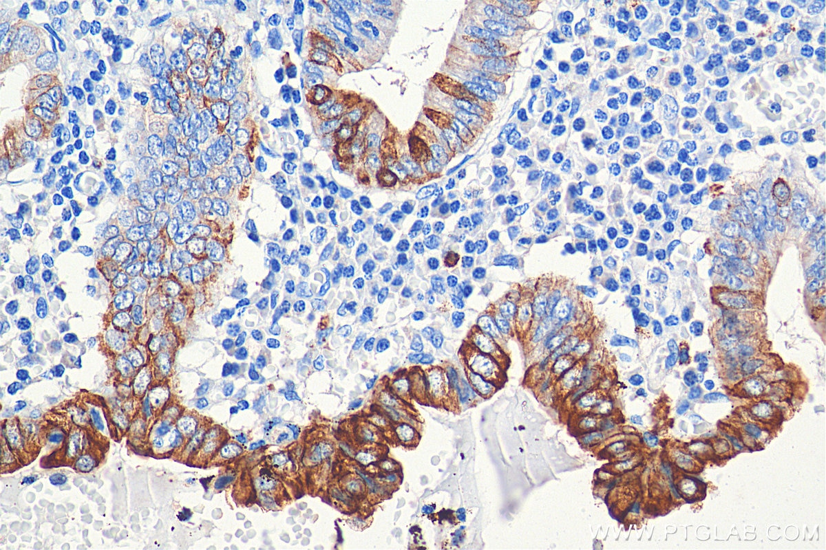 Immunohistochemistry (IHC) staining of human appendicitis tissue using Cytokeratin 20 Polyclonal antibody (17329-1-AP)