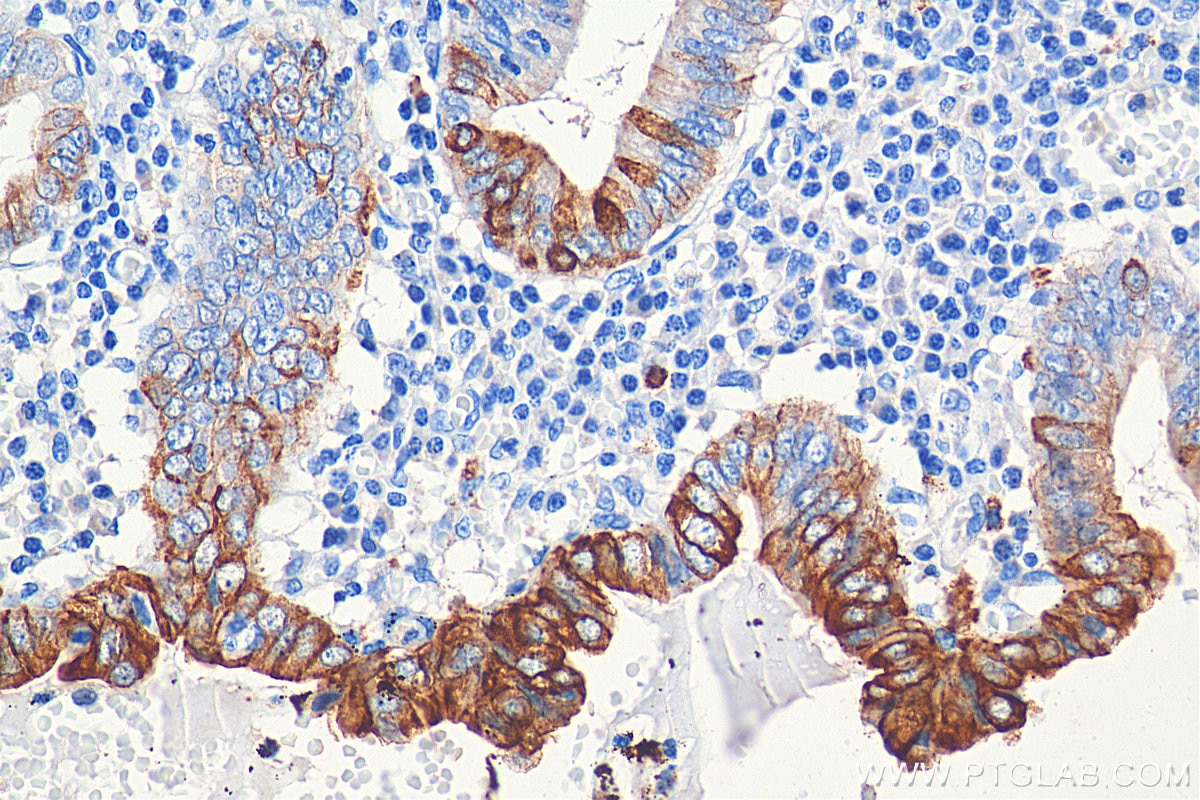 IHC staining of human appendicitis using 17329-1-AP