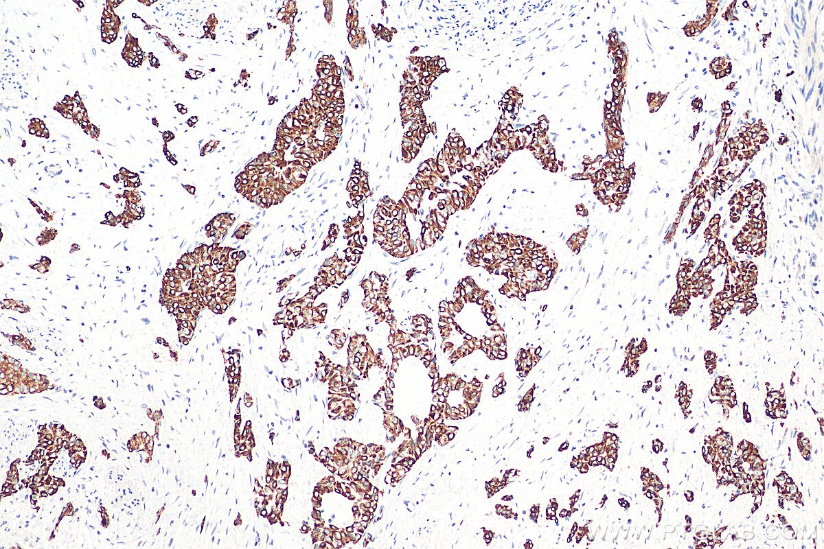 IHC staining of human urothelial carcinoma using 17329-1-AP
