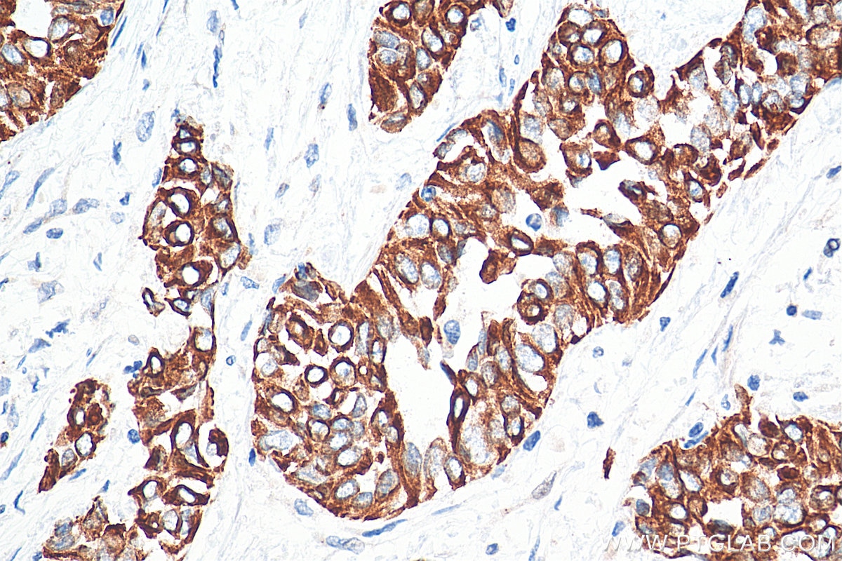 Immunohistochemistry (IHC) staining of human urothelial carcinoma tissue using Cytokeratin 20 Polyclonal antibody (17329-1-AP)
