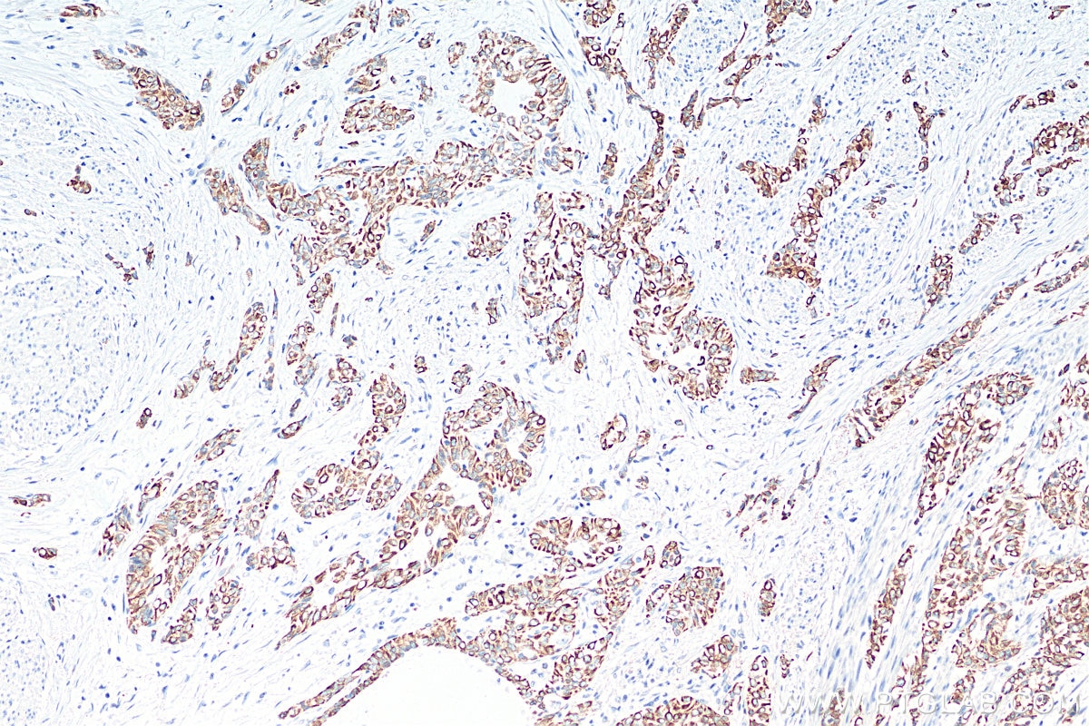 Immunohistochemistry (IHC) staining of human urothelial carcinoma tissue using Cytokeratin 20 Polyclonal antibody (17329-1-AP)