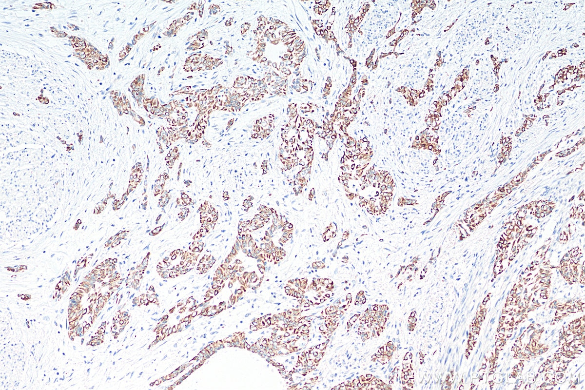 IHC staining of human urothelial carcinoma using 17329-1-AP