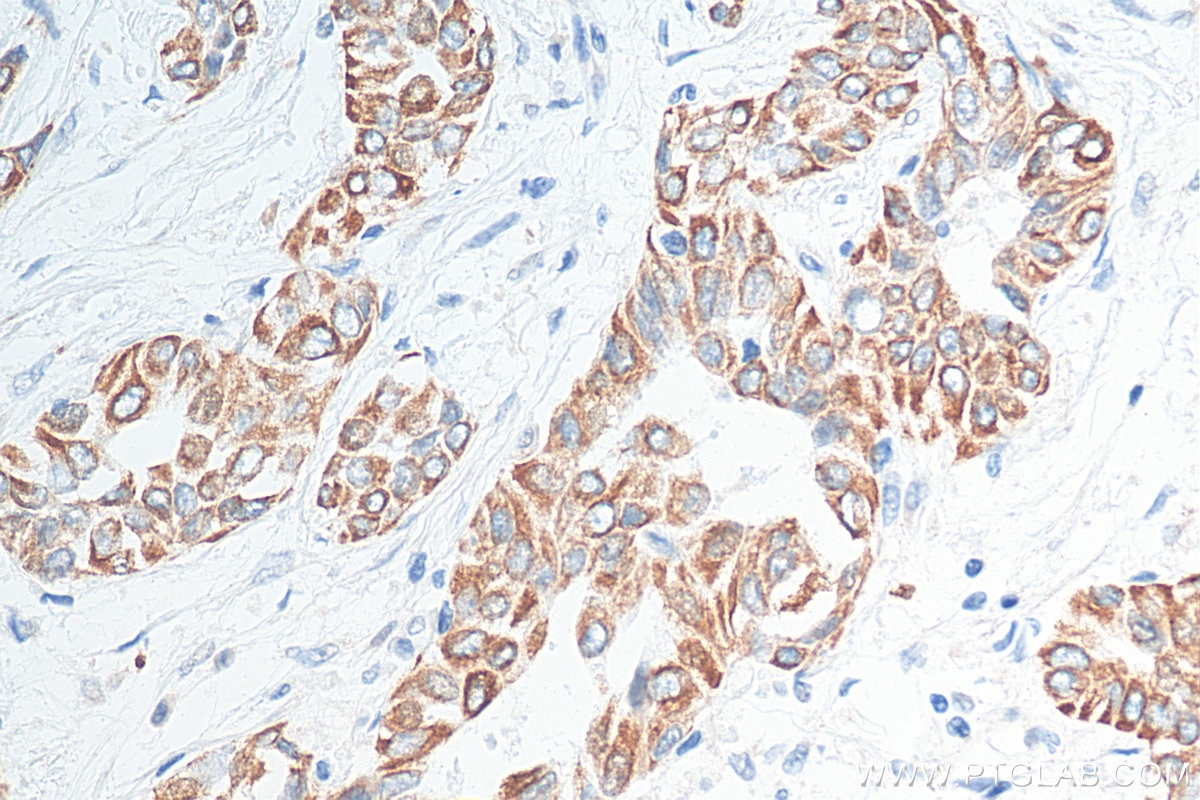 Immunohistochemistry (IHC) staining of human urothelial carcinoma tissue using Cytokeratin 20 Polyclonal antibody (17329-1-AP)