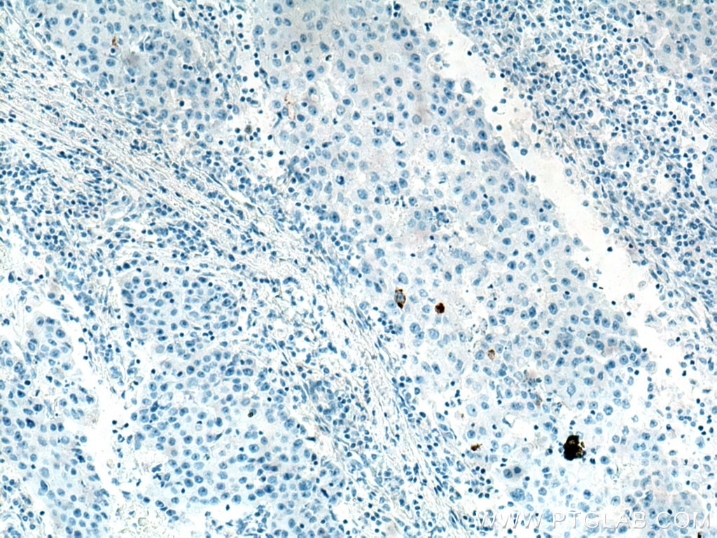 IHC staining of human breast cancer using 60183-1-Ig