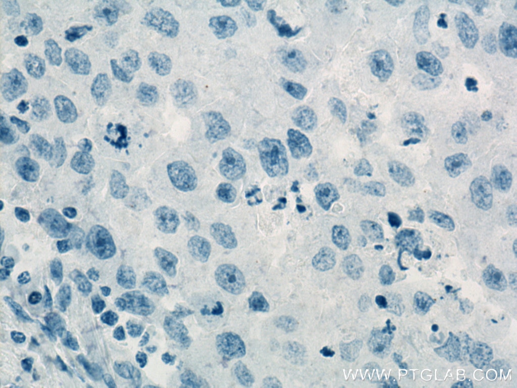 Immunohistochemistry (IHC) staining of human breast cancer tissue using Cytokeratin 20 Monoclonal antibody (60183-1-Ig)