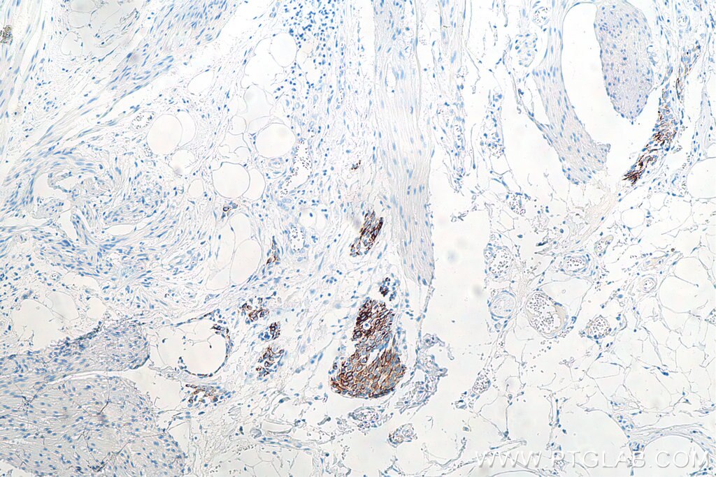 Immunohistochemistry (IHC) staining of human urothelial carcinoma tissue using Cytokeratin 20 Monoclonal antibody (60183-1-Ig)