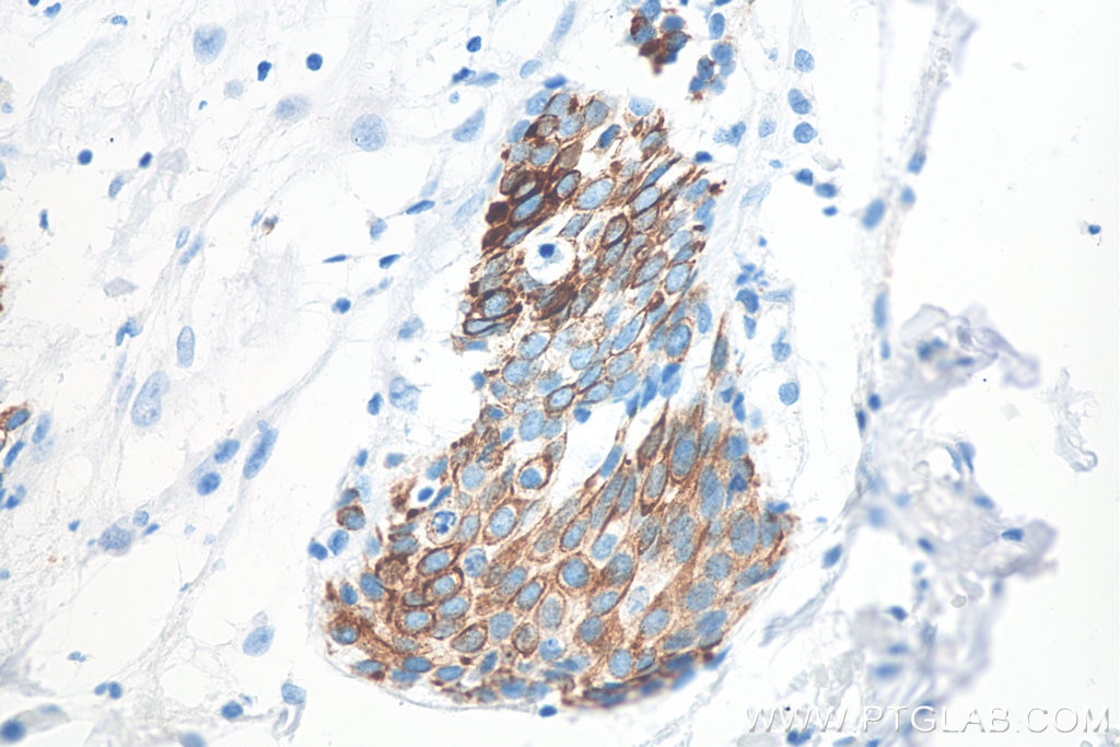 Immunohistochemistry (IHC) staining of human urothelial carcinoma tissue using Cytokeratin 20 Monoclonal antibody (60183-1-Ig)