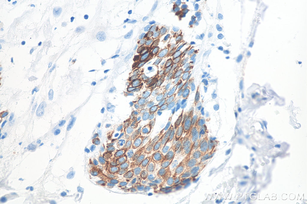 IHC staining of human urothelial carcinoma using 60183-1-Ig