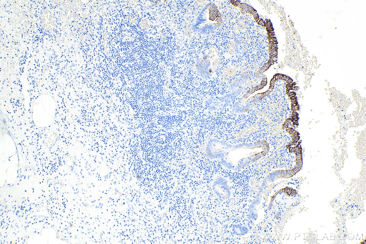 Immunohistochemistry (IHC) staining of human appendicitis tissue using Cytokeratin 20 Monoclonal antibody (60183-1-Ig)