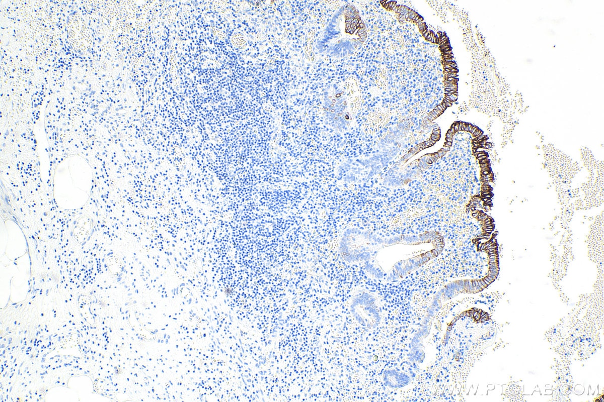 IHC staining of human appendicitis using 60183-1-Ig