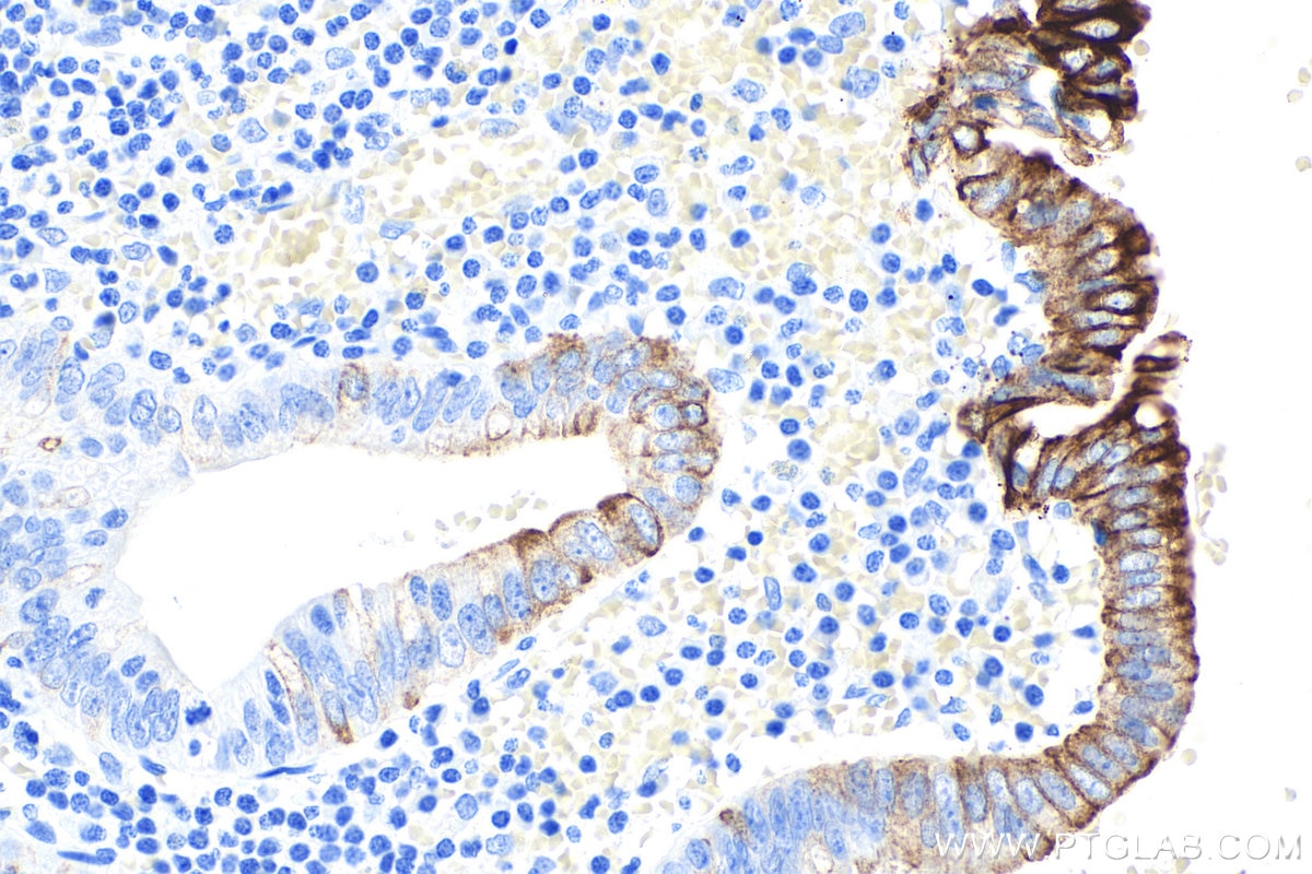 Immunohistochemistry (IHC) staining of human appendicitis tissue using Cytokeratin 20 Monoclonal antibody (60183-1-Ig)