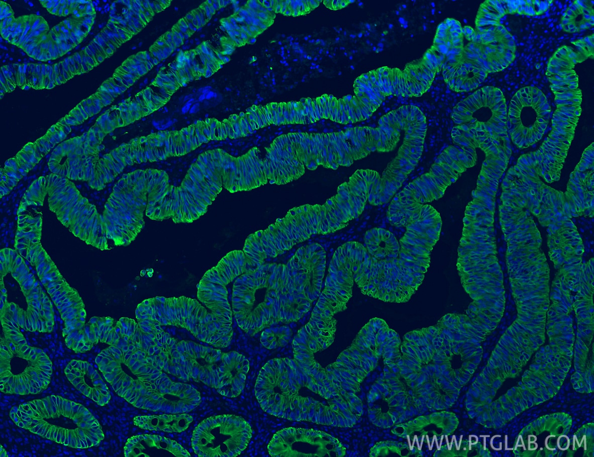 Immunofluorescence (IF) / fluorescent staining of human colon cancer tissue using Cytokeratin 20 Recombinant monoclonal antibody (82428-1-RR)