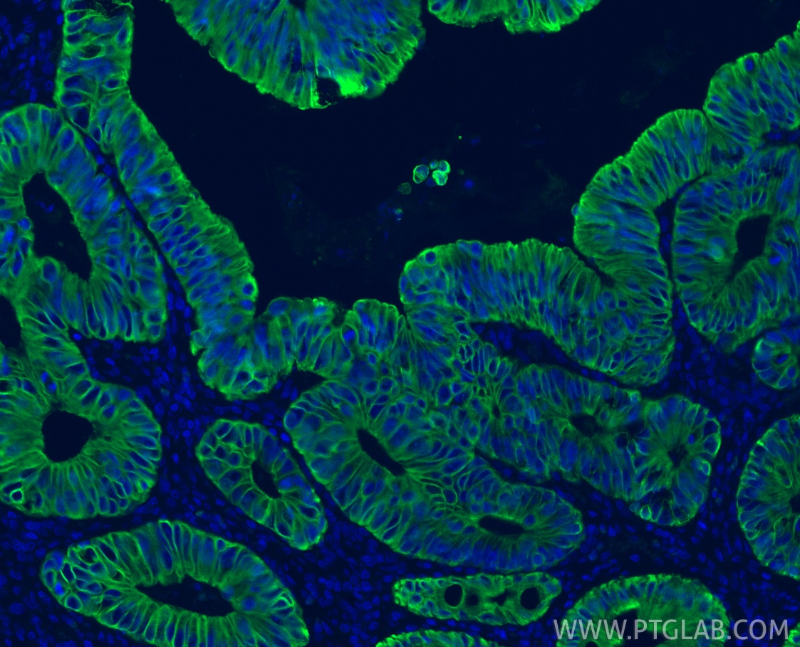 Immunofluorescence (IF) / fluorescent staining of human colon cancer tissue using Cytokeratin 20 Recombinant monoclonal antibody (82428-1-RR)
