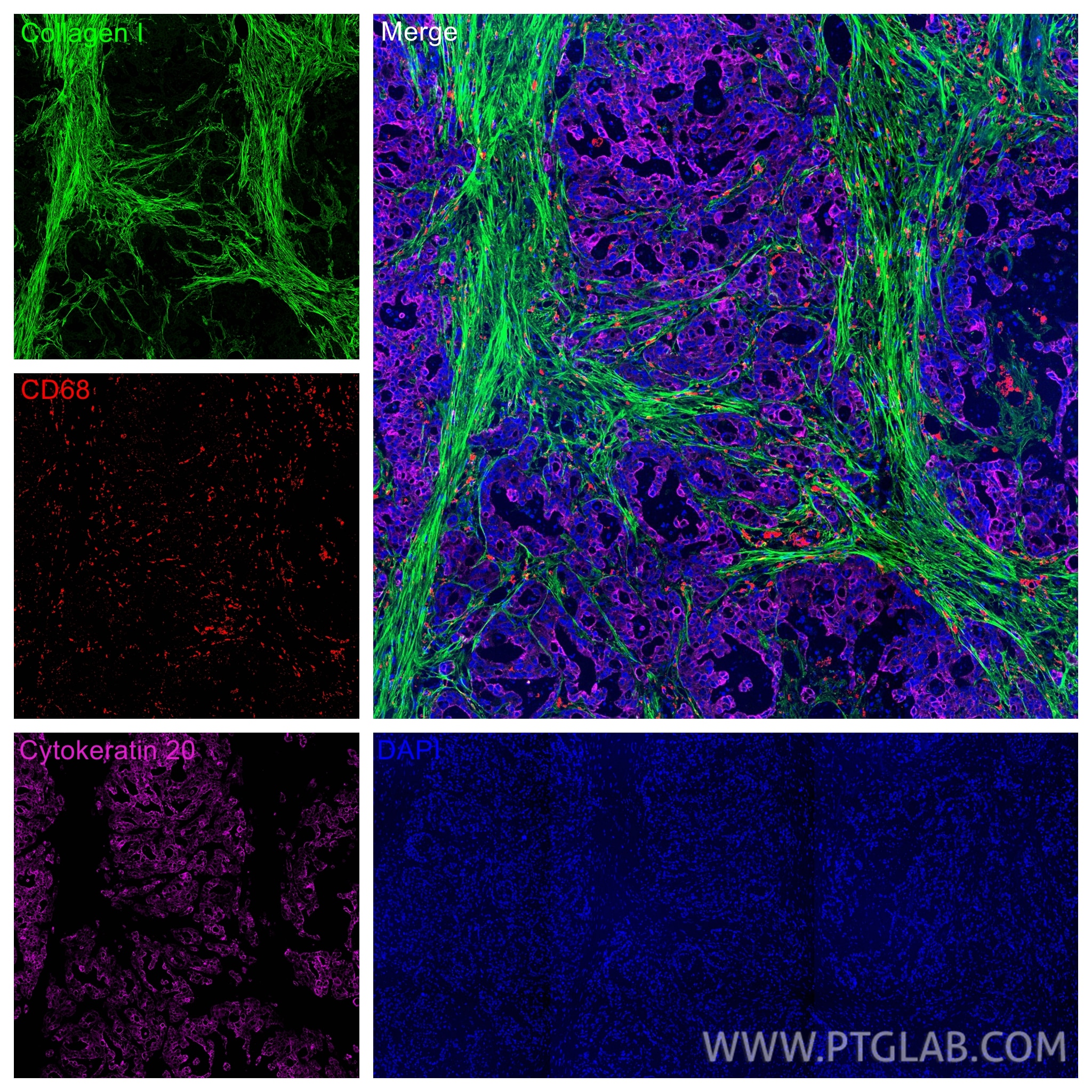 Immunofluorescence (IF) / fluorescent staining of human colon cancer tissue using Cytokeratin 20 Recombinant monoclonal antibody (82428-1-RR)