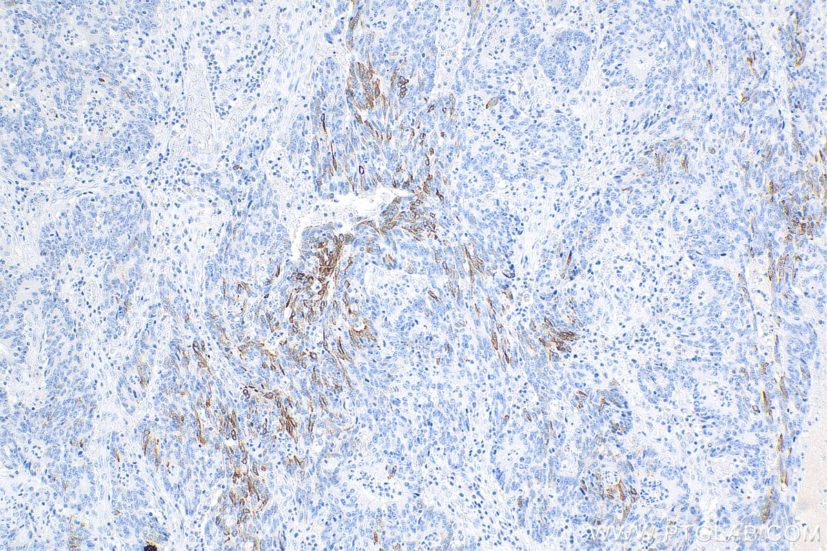 Immunohistochemistry (IHC) staining of human colon cancer tissue using Cytokeratin 20 Recombinant antibody (82428-1-RR)