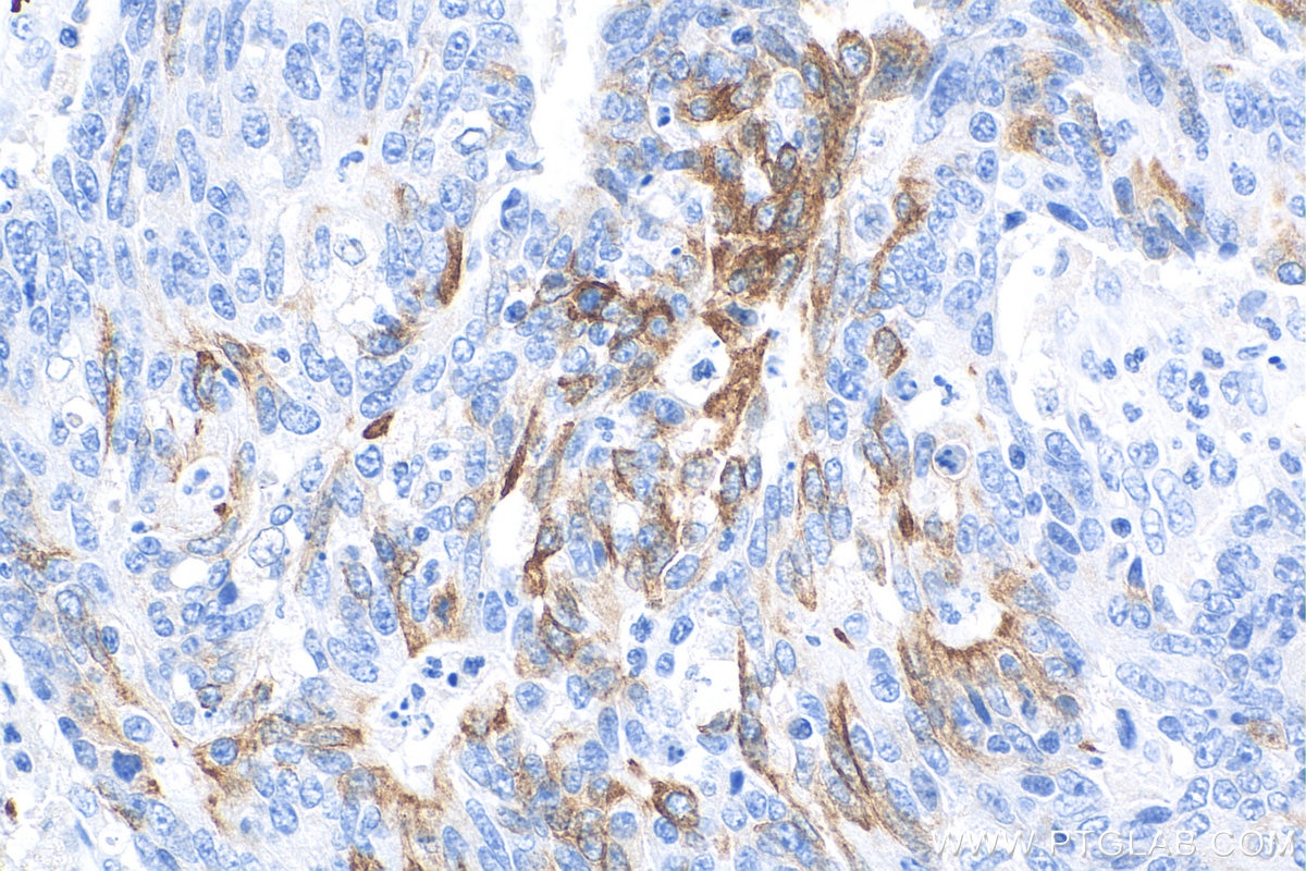 Immunohistochemistry (IHC) staining of human colon cancer tissue using Cytokeratin 20 Recombinant antibody (82428-1-RR)