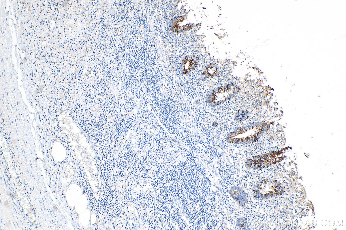 Immunohistochemistry (IHC) staining of human appendicitis tissue using Cytokeratin 20 Recombinant antibody (82428-1-RR)