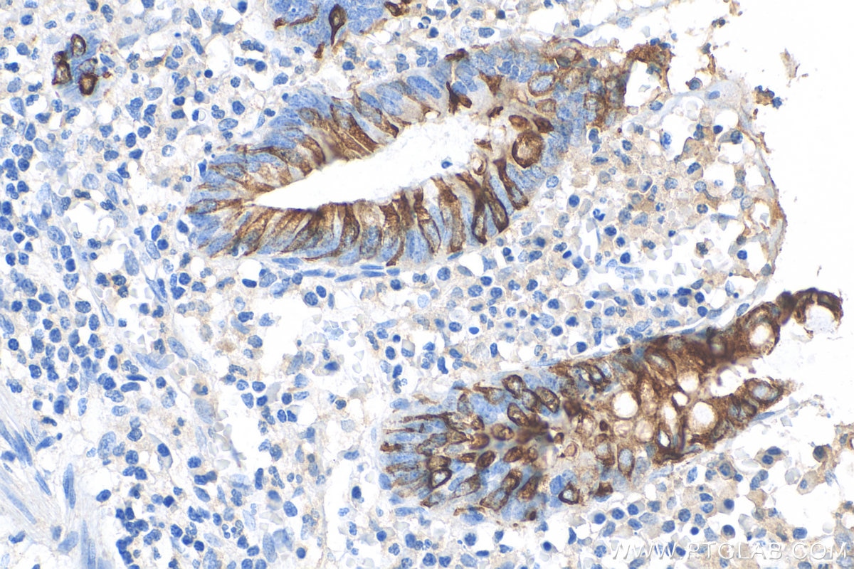 Immunohistochemistry (IHC) staining of human appendicitis tissue using Cytokeratin 20 Recombinant antibody (82428-1-RR)