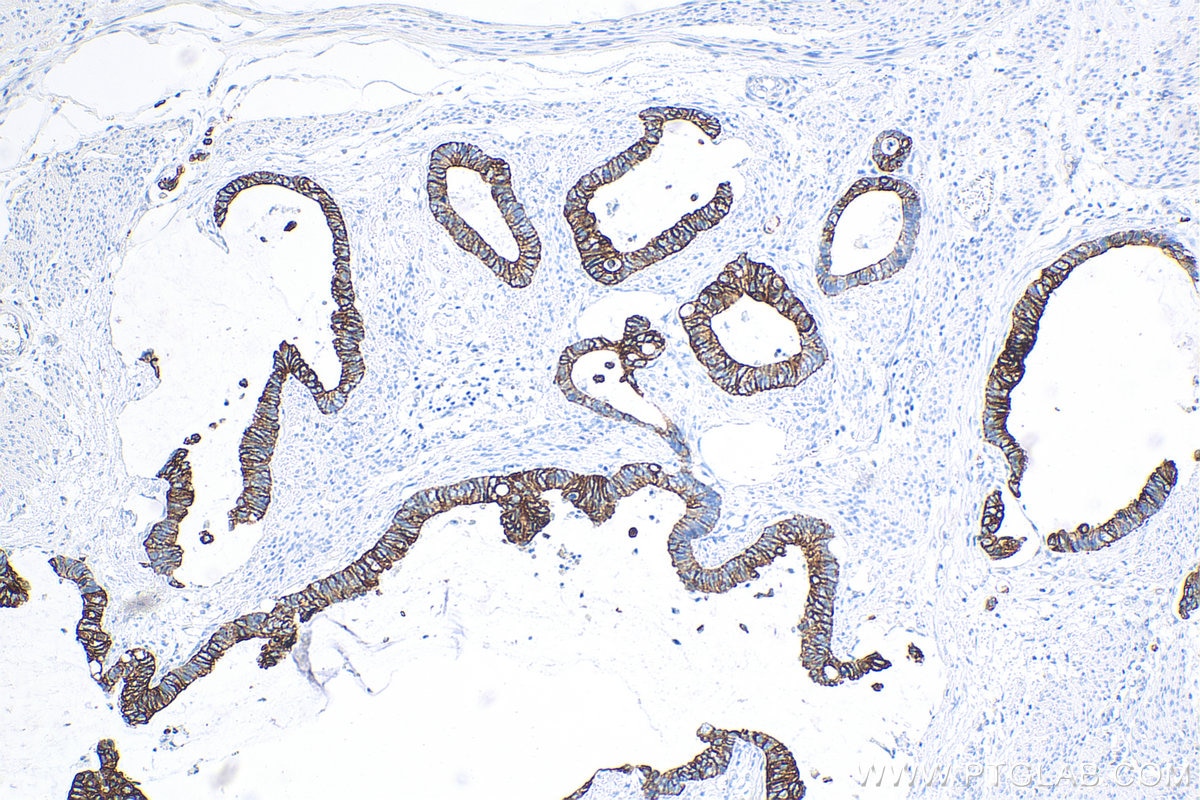 Immunohistochemistry (IHC) staining of human urothelial carcinoma tissue using Cytokeratin 20 Recombinant antibody (82428-1-RR)