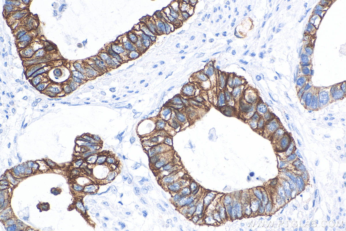 Immunohistochemistry (IHC) staining of human urothelial carcinoma tissue using Cytokeratin 20 Recombinant antibody (82428-1-RR)