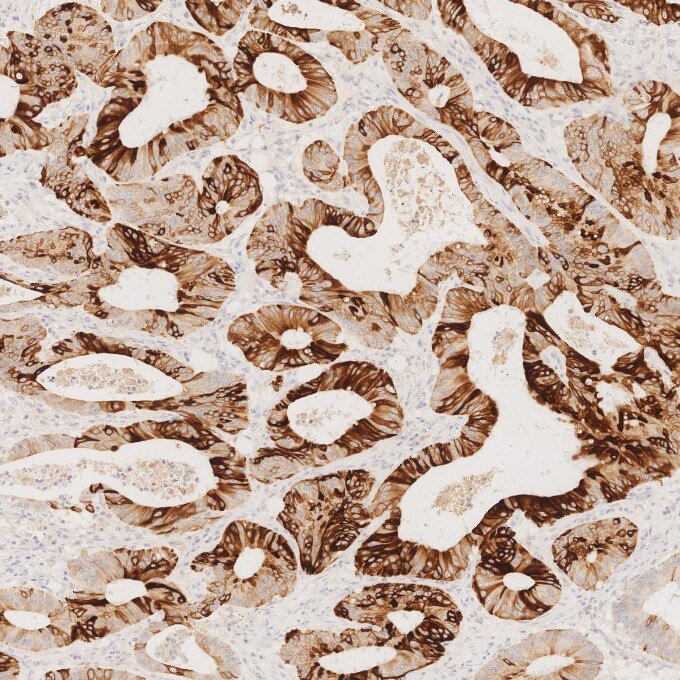 Immunohistochemistry (IHC) staining of human colorectal cancer tissue using Cytokeratin 20 Recombinant monoclonal antibody (82428-1-RR)