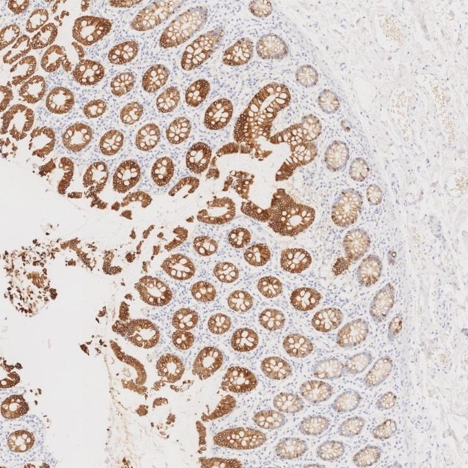 Immunohistochemistry (IHC) staining of human colorectal cancer tissue using Cytokeratin 20 Recombinant monoclonal antibody (82428-1-RR)