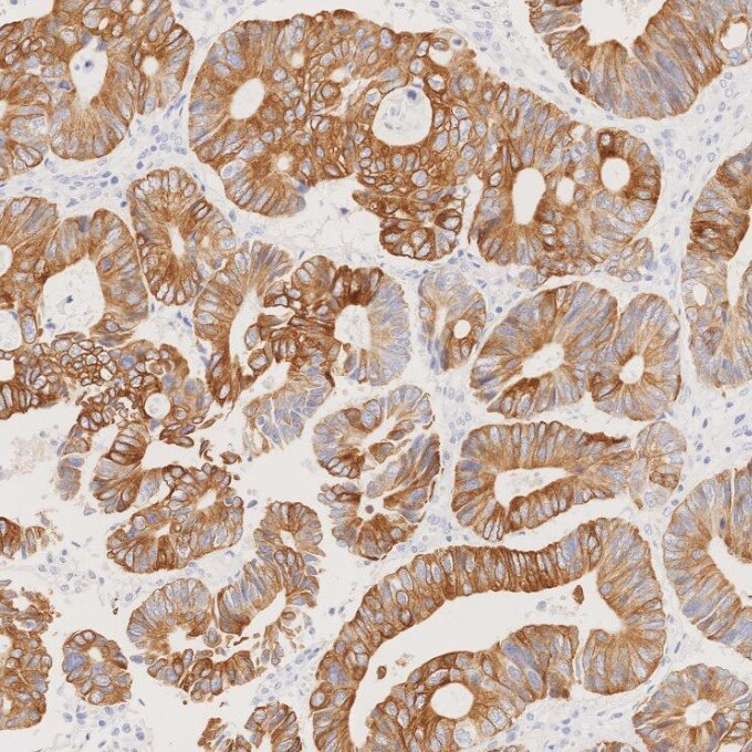 Immunohistochemistry (IHC) staining of human colorectal cancer tissue using Cytokeratin 20 Recombinant monoclonal antibody (82428-1-RR)