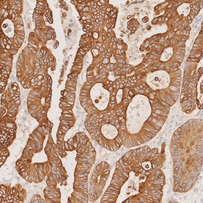 Immunohistochemistry (IHC) staining of human colorectal cancer tissue using Cytokeratin 20 Recombinant monoclonal antibody (82428-1-RR)