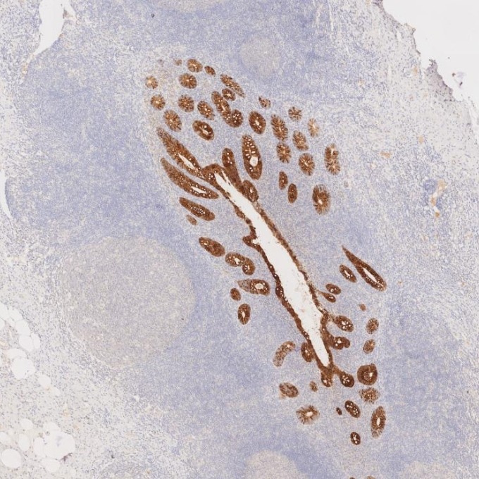 Immunohistochemistry (IHC) staining of human appendicitis tissue using Cytokeratin 20 Recombinant monoclonal antibody (82428-1-RR)