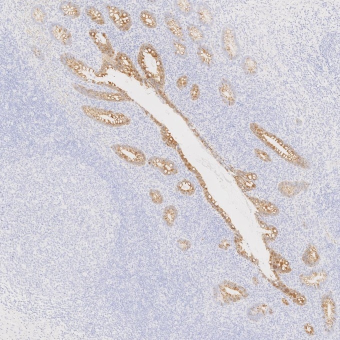 Immunohistochemistry (IHC) staining of human appendicitis tissue using Cytokeratin 20 Recombinant monoclonal antibody (82428-1-RR)