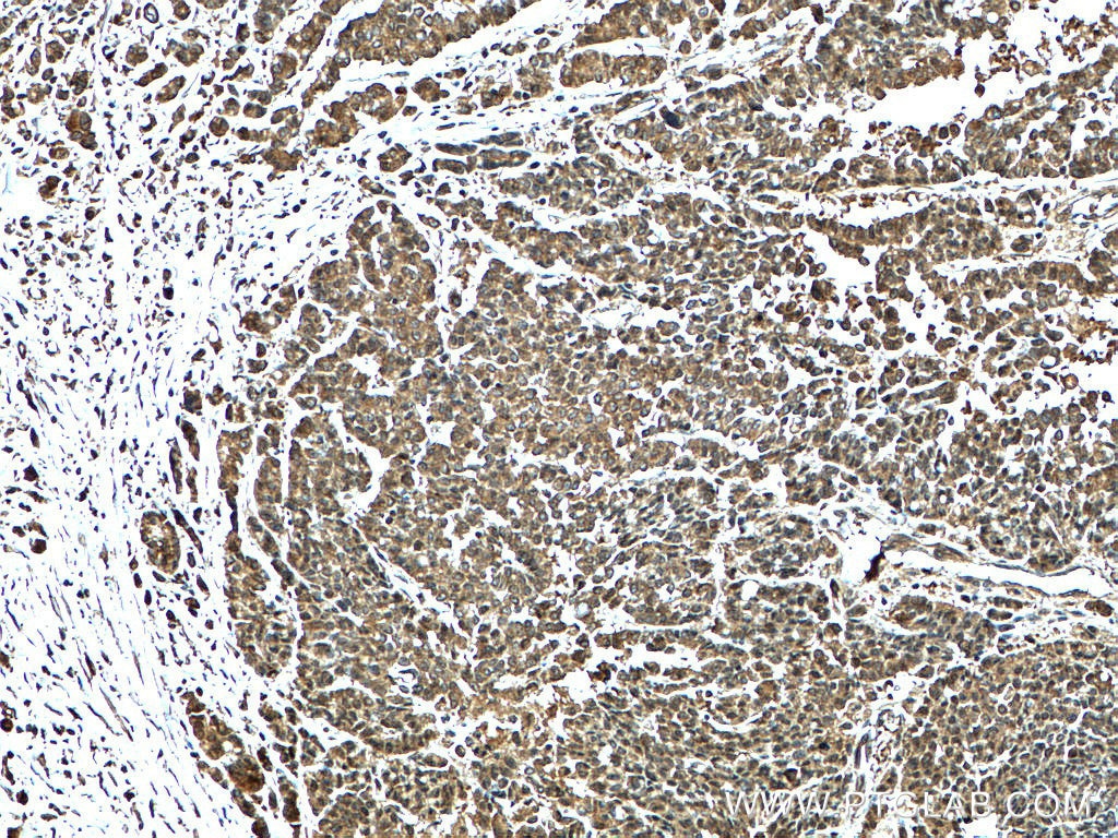 Immunohistochemistry (IHC) staining of human colon cancer tissue using KRT23 Polyclonal antibody (24049-1-AP)