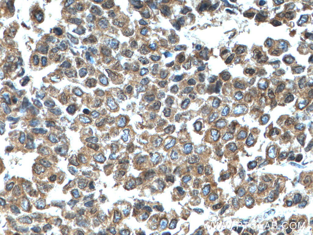 Immunohistochemistry (IHC) staining of human colon cancer tissue using KRT23 Polyclonal antibody (24049-1-AP)