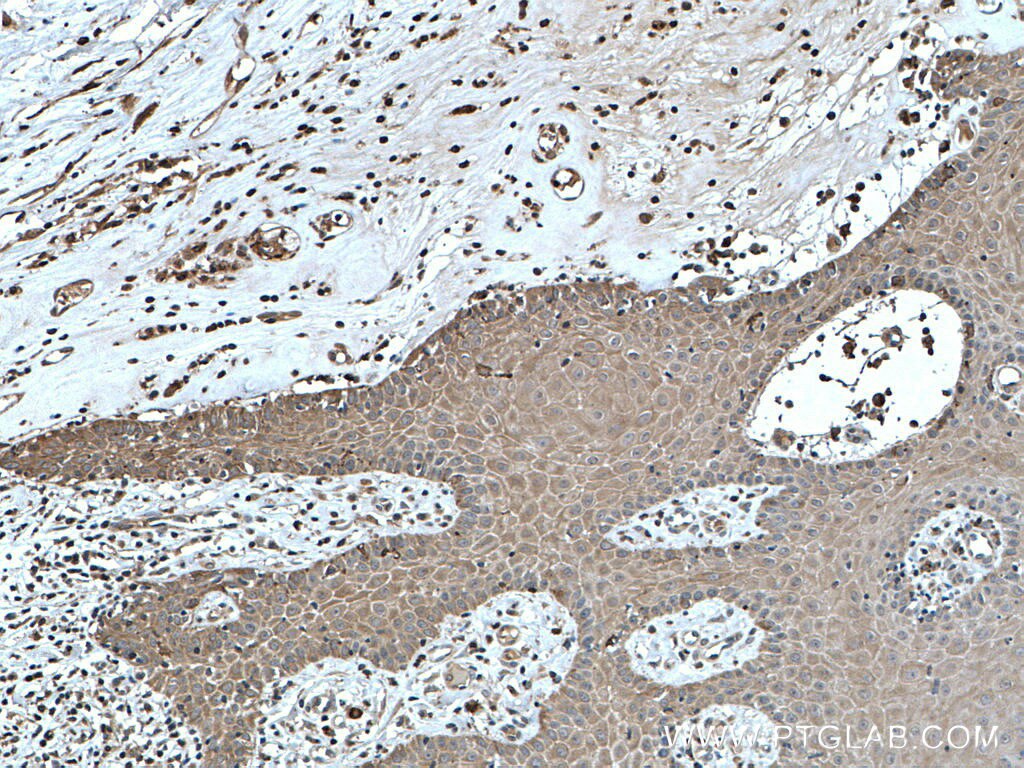 Immunohistochemistry (IHC) staining of human skin cancer tissue using KRT23 Polyclonal antibody (24049-1-AP)