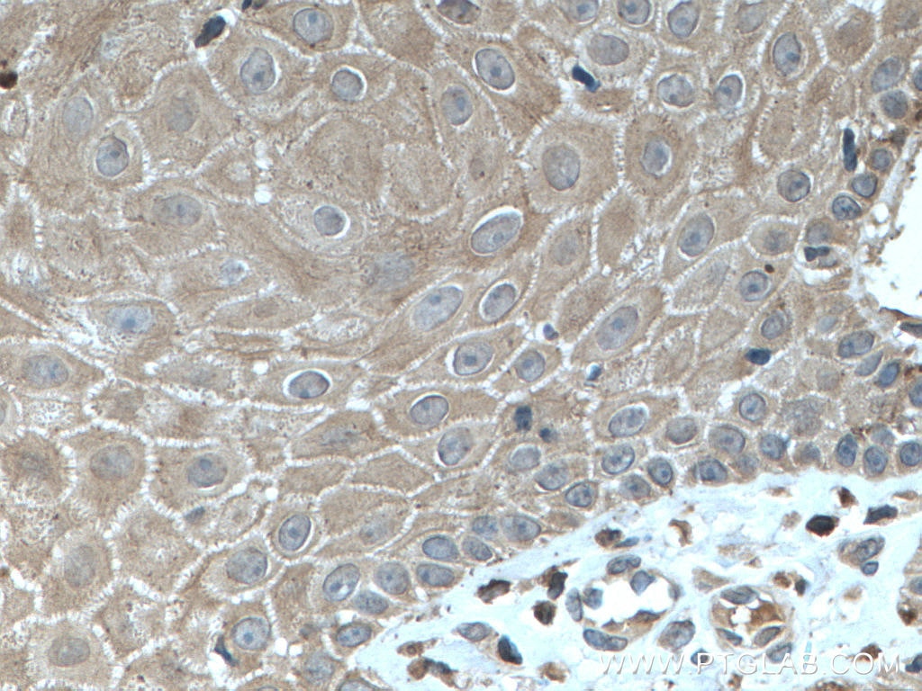 Immunohistochemistry (IHC) staining of human skin cancer tissue using KRT23 Polyclonal antibody (24049-1-AP)