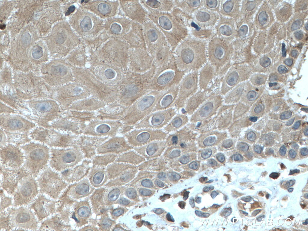 IHC staining of human skin cancer using 24049-1-AP