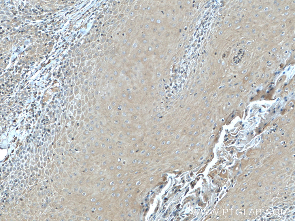 Immunohistochemistry (IHC) staining of human skin cancer tissue using KRT23 Polyclonal antibody (24049-1-AP)