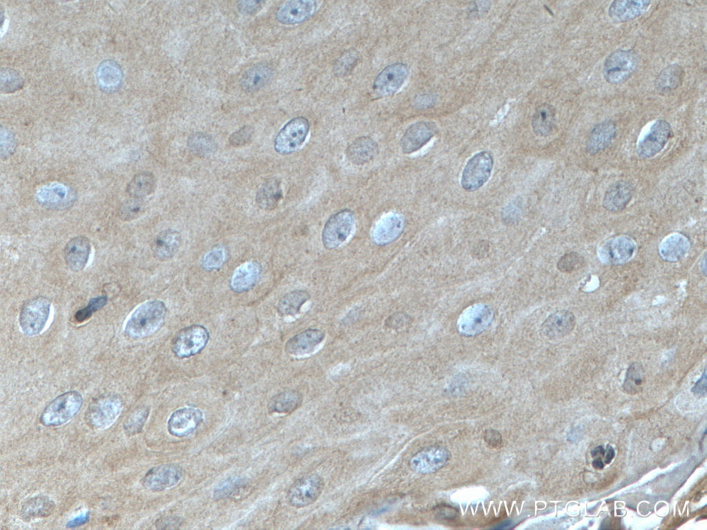 IHC staining of human skin cancer using 24049-1-AP