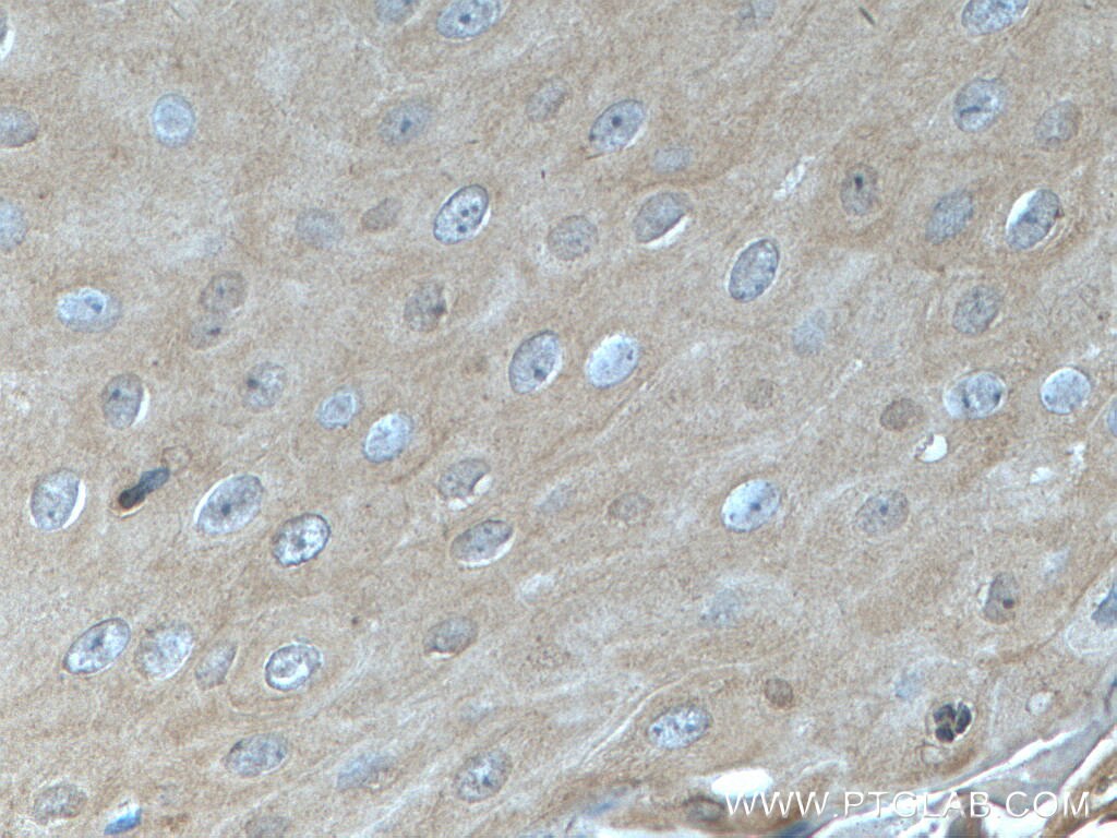 Immunohistochemistry (IHC) staining of human skin cancer tissue using KRT23 Polyclonal antibody (24049-1-AP)